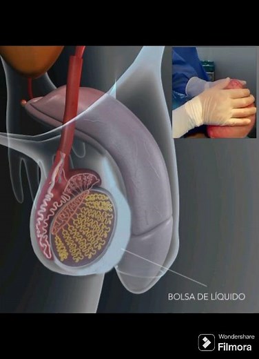 Hidrocele a nivel testicular.