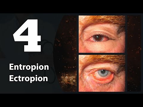 4- Eye lids (Entropion & Ectropion)