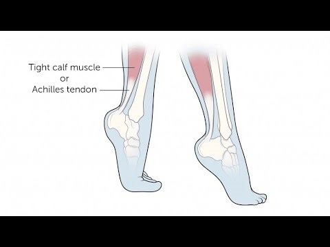 How to stop toe walking/ Causes/ Exercises at home