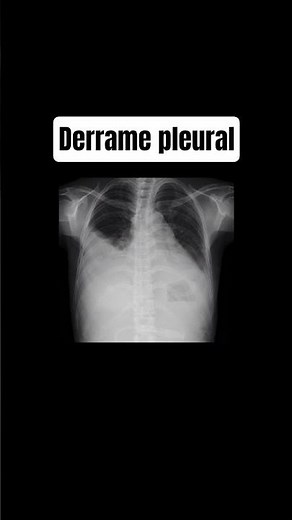 pleural effusion symptoms #effusion #pleuraleffusion #medicine #health #drbernardovelasco