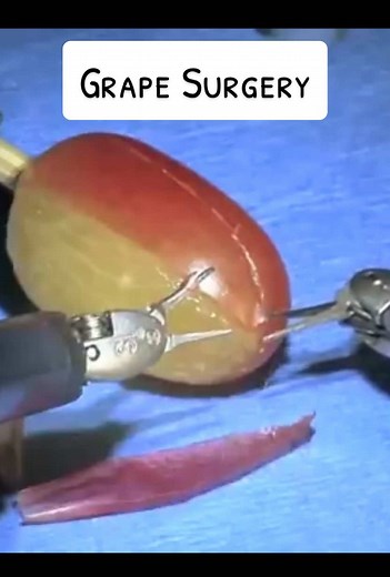 Da Vinci Robotic Grape Surgery Explained