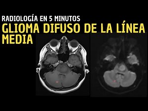 Radiology in 5 minutes: Diffuse midline glioma.