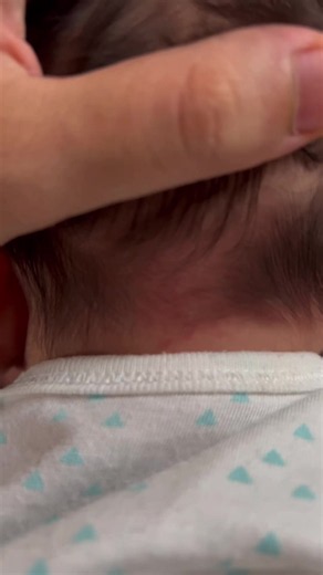 What Are Stork Bites on Babies? Meaning of Red Birth Patches