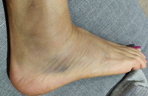 How To Heal a Grade 2 Ankle Sprain Fully & Fast
