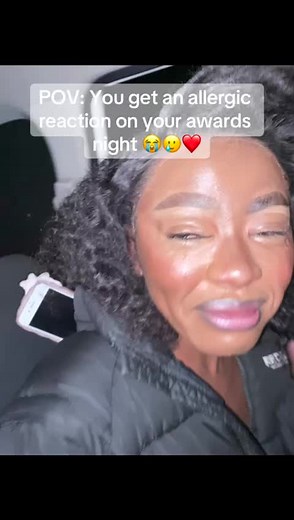 Life-Threatening Allergic Reaction to Prawns - Rushed to Hospital in Time