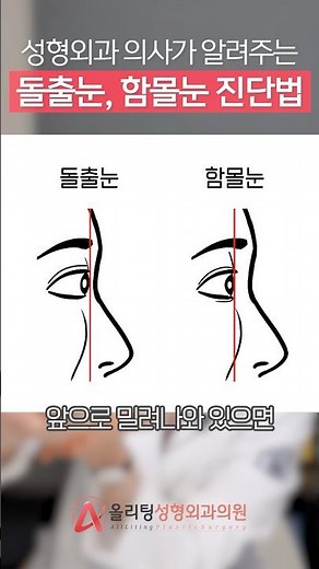 성형외과 의사가 알려주는 돌출눈, 함몰눈 진단법