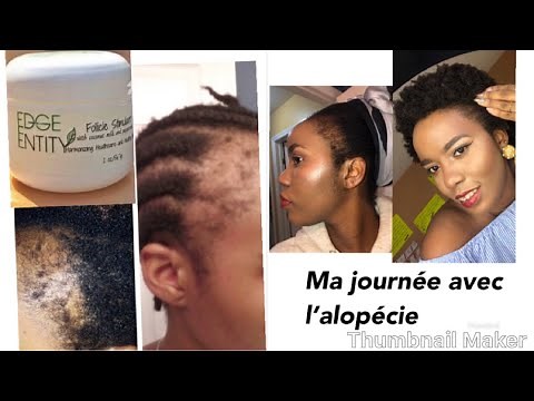 Alopécie et ma pousse? Produits et explications part1