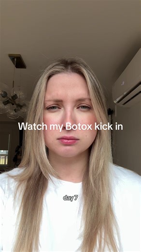 Watch My Botox Results: Before and After Transformation