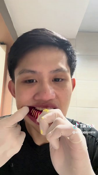 Making Retainers After Braces: A Dental Student's POV