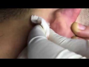SECRET BEHIND EAR ACNE EXTRACTION - Blackhead Removal