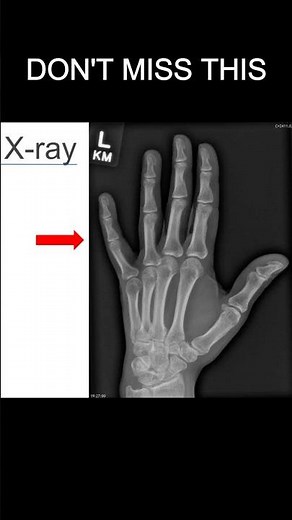 Oblique Hand X-ray Positioning: Is This Correct?
