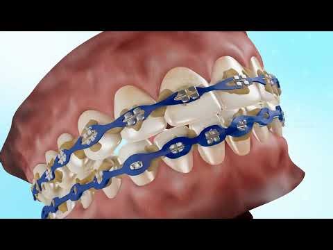 Customized Elastic Chains Improve Orthodontic Force | 3D Medical Animation Company & Studio | EFFE