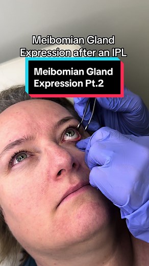 Meibomian Gland Expression: After IPL Treatment