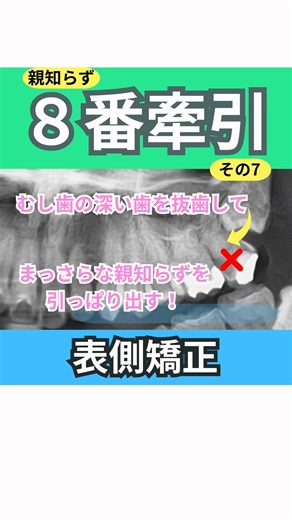 むし歯の深い左上7番を抜歯して歯茎の中のまっさらな親知らずを引っ張り出す矯正症例動画です。小臼歯4本抜歯して出っ歯も治してます。 #矯正歯科 #親知らず#wisdomteeth #インプラント