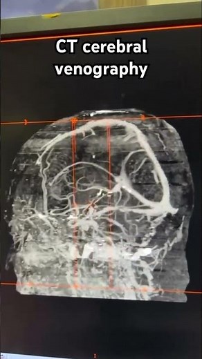 CT cerebral venography #brainvenogram #venography #shorts #anatomy