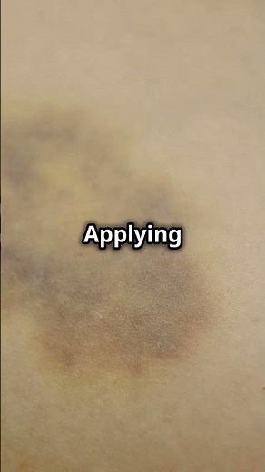 How to Heal Bruises Faster