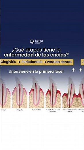 Las Etapas de la Enfermedad Periodontal 🦷⚠️ Dental Artistry