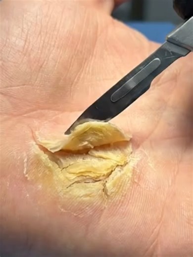 Palm Callus Removal | Detailed Hand Debridement ASMR (Clinical Close-Up) #asmr #handcare #callusremoval #medicalasmr #skintreatment