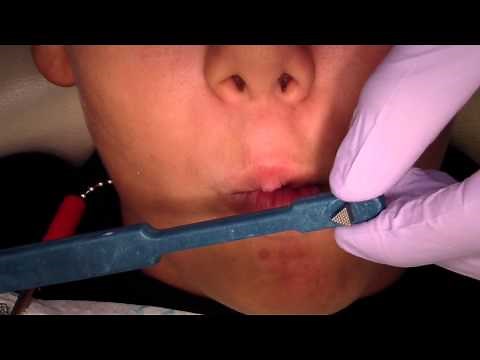 Orthodontic Band Seating 101