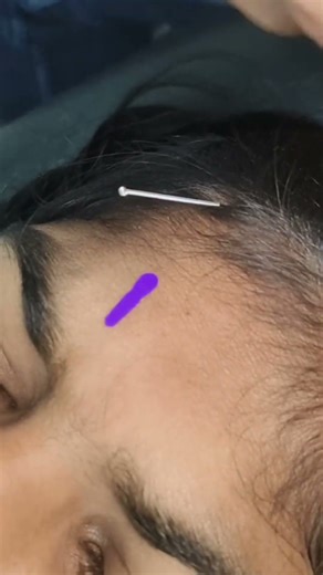 dry needling for headache #dr.baljinder goniana mandi