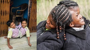 In this Born Different special we introduce three sets of conjoined twins from around the world | Born Different