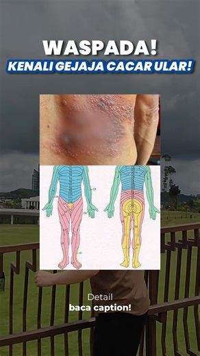 Pahami Cacar Api: Gejala dan Penanganan Dini