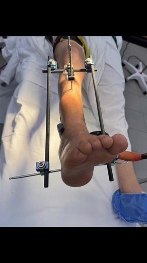 External Fixation in Orthopedics: A Healing Journey