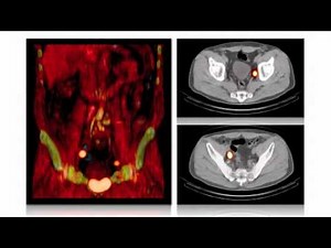 Prostate Cancer - Laparoscopic Fluorescence Sentinel Lymph Node Guidance • Video • MEDtube.net