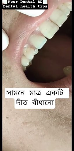 A loose tooth in the front is fixed Dental Denture Teeth @DentalHealthTips