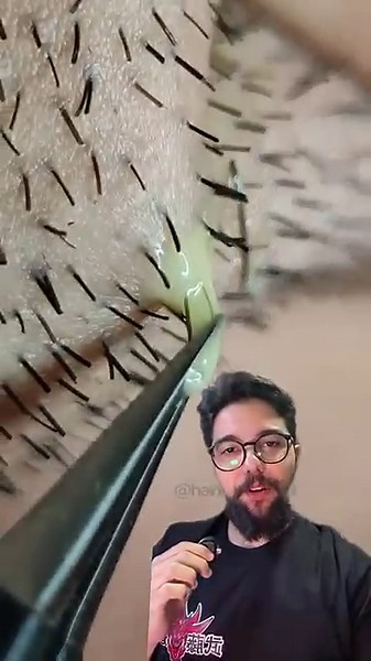 Pelo encravado #barba #barbeiro #barbudo #barbarobusta #donalcides