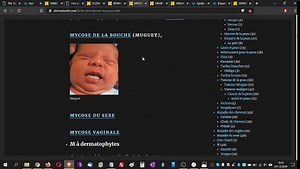 MYCOSE : causes, symptomes, traitement