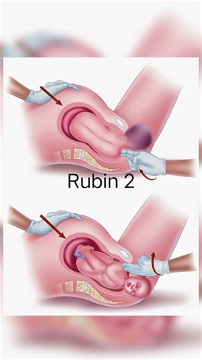 𝐄𝐗𝐏𝐋𝐎𝐑𝐄 𝐍𝐔𝐑𝐒𝐈𝐍𝐆 🎯✨ on Instagram: "Important Obstetric Maneuvers 📖 Frequently asked in exams & crucial in labor room practice. Learn • Remember • Apply 👶 #obg #nursingstudent #examprep"