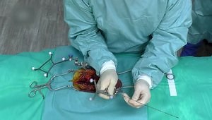 Navigated S2-Alar-Iliac Screw Placement Using Power-Assisted Tools - Part 7 of 8 Treatment Options in Navigated Lumbosacral Spine