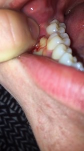 My wisdom tooth surgical site is clearly infected, watch as I express some sort of gushing orb of pus on my gum.