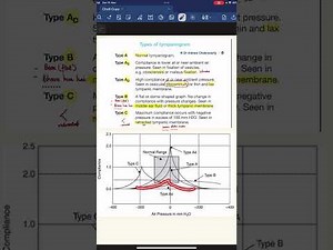 Let’s Learn to interpret a tympanogram and never forget it👂