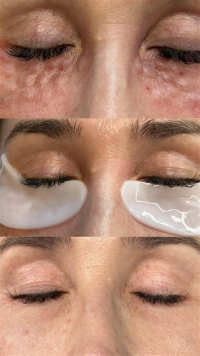 Paula Agustina Comisso on Instagram: "Redensificación dérmica en ojera: Beneficios ✨ ✅ promueve la renovación celular a nivel de la dermis (piel nueva y mas fuerte) ✅ hidrata ✅nutre ✅ repara el ADN celular 🧬 ¿Qué esperas para probarlo? ✨🫶🏻 📲 351 - 75 05 007 📍 Sáenz Peña - CHACO. Argentina. #ojera #mesoterapia #cuidadodelapiel #softskin #armonizaciónfacial"
