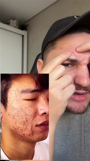 Effective Green Mask for Blackheads Removal