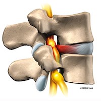 Herniated Disc - Vancouver Spine Doctor