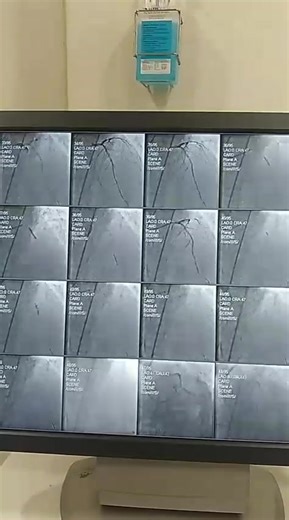 Successful PTCA done in a severely calcified LAD with IVL IVUS guided. | Dr.Mukul kaushik