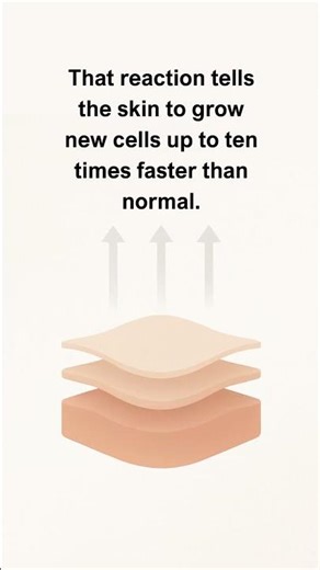 Plaque Psoriasis Explained: Why Plaques Aren’t “Dry Skin” | Understanding Psoriasis (Part 1)