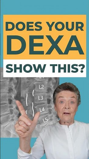 Is Your DEXA Showing Signs of THIS?