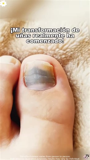 🍃 Για πολύ καιρό έψαχνα κάτι που να βοηθά τα νύχια και το δέρμα. Με αυτή την αλοιφή άρχισα να βλέπω πιο καθαρό δέρμα και καλύτερη όψη στα νύχια. ✨