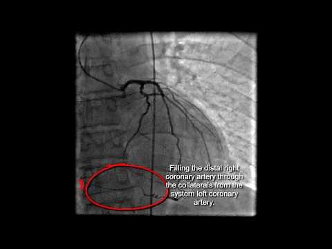 The second stent placement in circumflex artery of the heart. Live case.