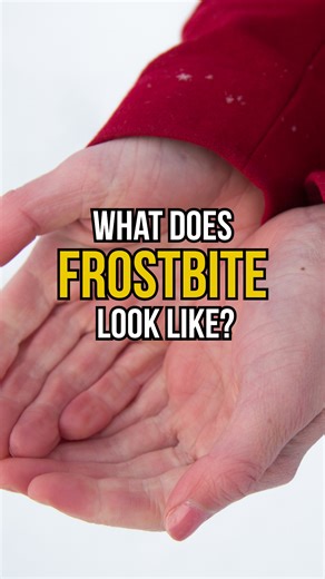 Frostbite can occur whenever temperatures are colder than 32 degrees. With Kentucky bracing for projected temperatures well below freezing for the next several days, Matthew Bozeman, M.D., explains the three stages of frostbite and what frostbite looks like at each stage. Signs, symptoms and ways to prevent frostbite ▶️ ULHealth.co/3O40DYa | UofL Health