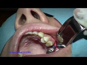 autogenous crestal bone sinus lift using "Densah" osseodensification burs