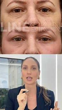 Fios de PDO são eficazes para flacidez em pálpebra inferior? Conheça o método Line Skin