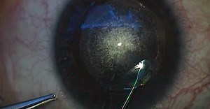 SMILE Full Case Technique - Eyetube