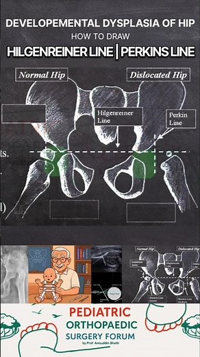 DDH XRAY Perkin & Hilgenreiner Line explained #ddh #hip #ortho #doctor #radiology #explained #
