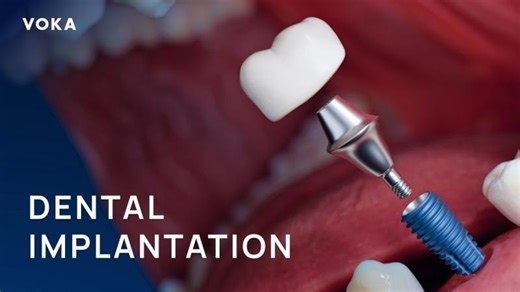 Dental Implant Surgery Step-by-Step 3D visualisation | Implant Placement Crown Restoration | Ilya Zamotin