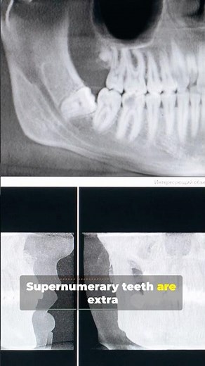 Extra Teeth: The Rare Condition!!! #tiktok